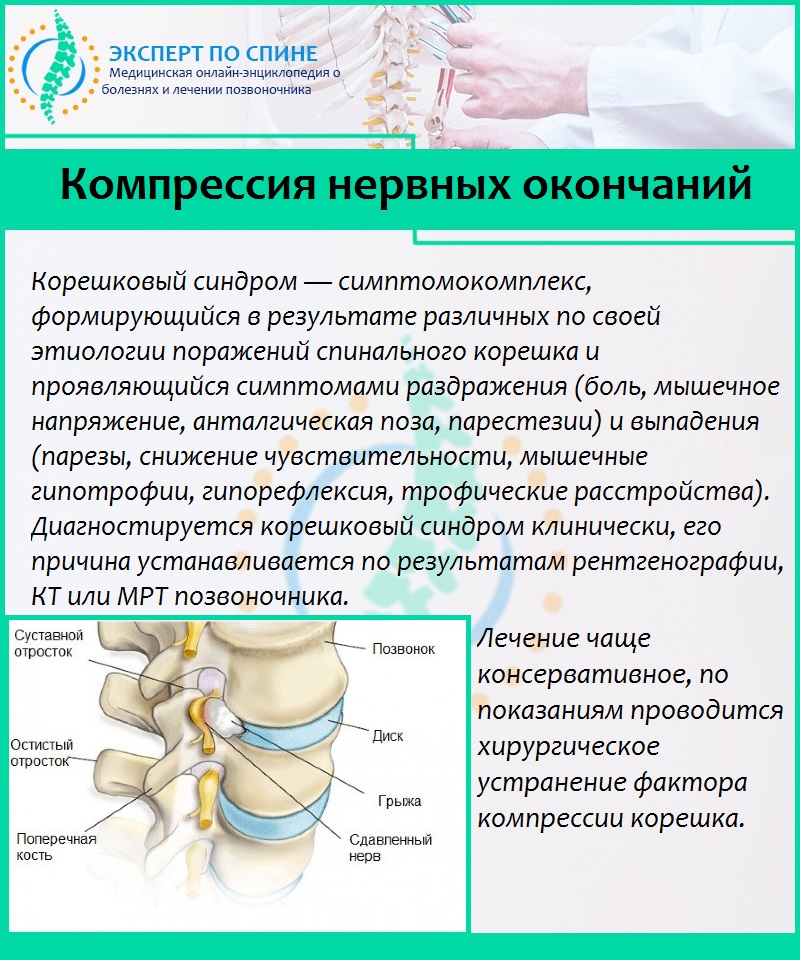 Компрессия нервных окончаний