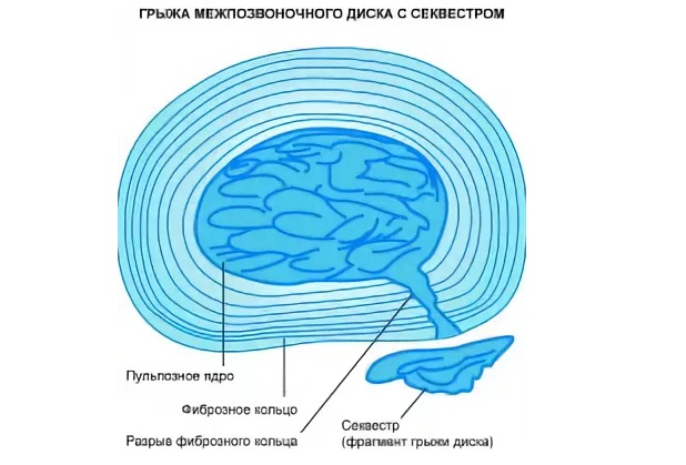 Секвестр на схеме
