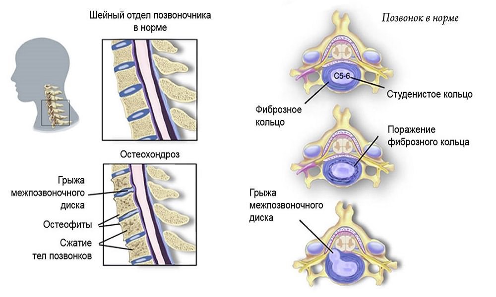 Шейный остеохондроз