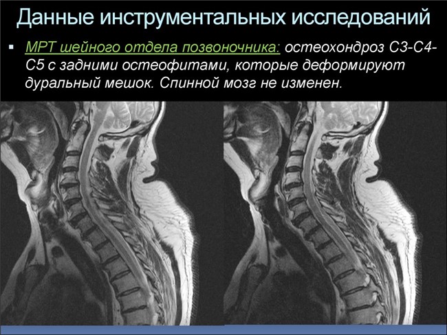  Шейный остеохондроз
