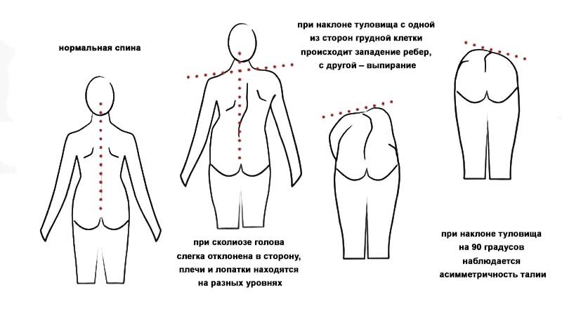 Симптоматика сколиоза