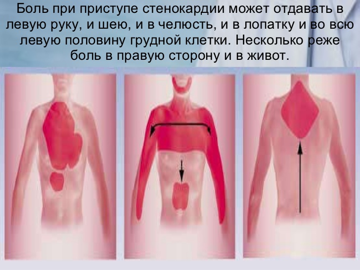 Симптоматика стенокардического приступа