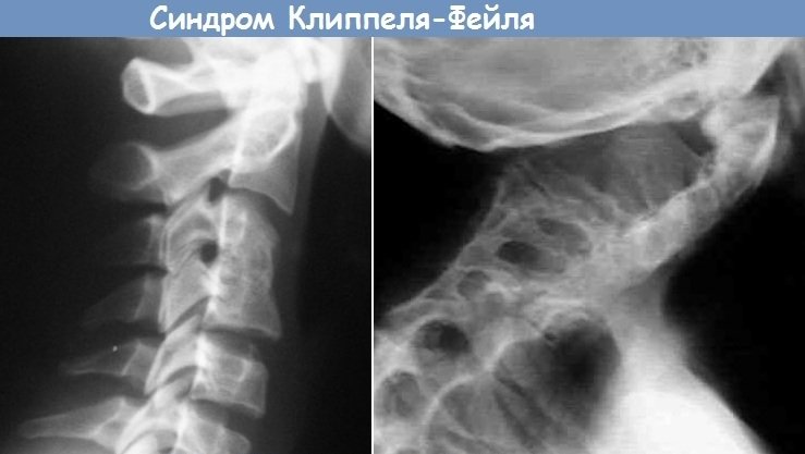 Синдром Клиппеля Фейля