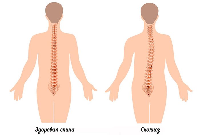 Сколиоз