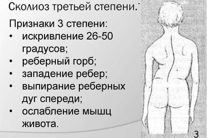 Сколиоз 3 степени