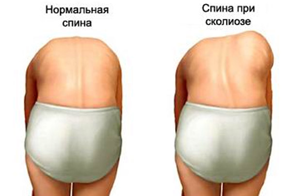 При сколиозе деформации проявляются четче в наклонном положении тела