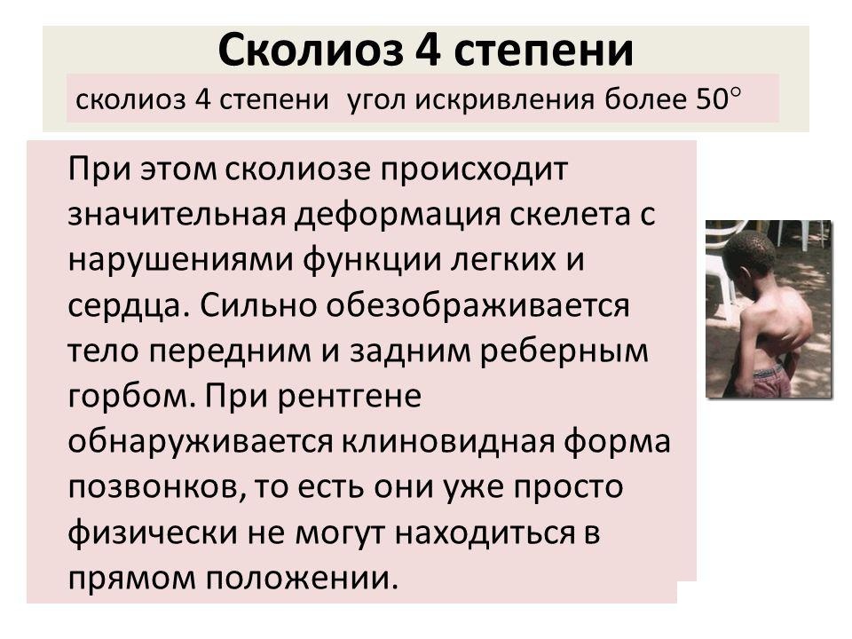Сколиоз 4 степени
