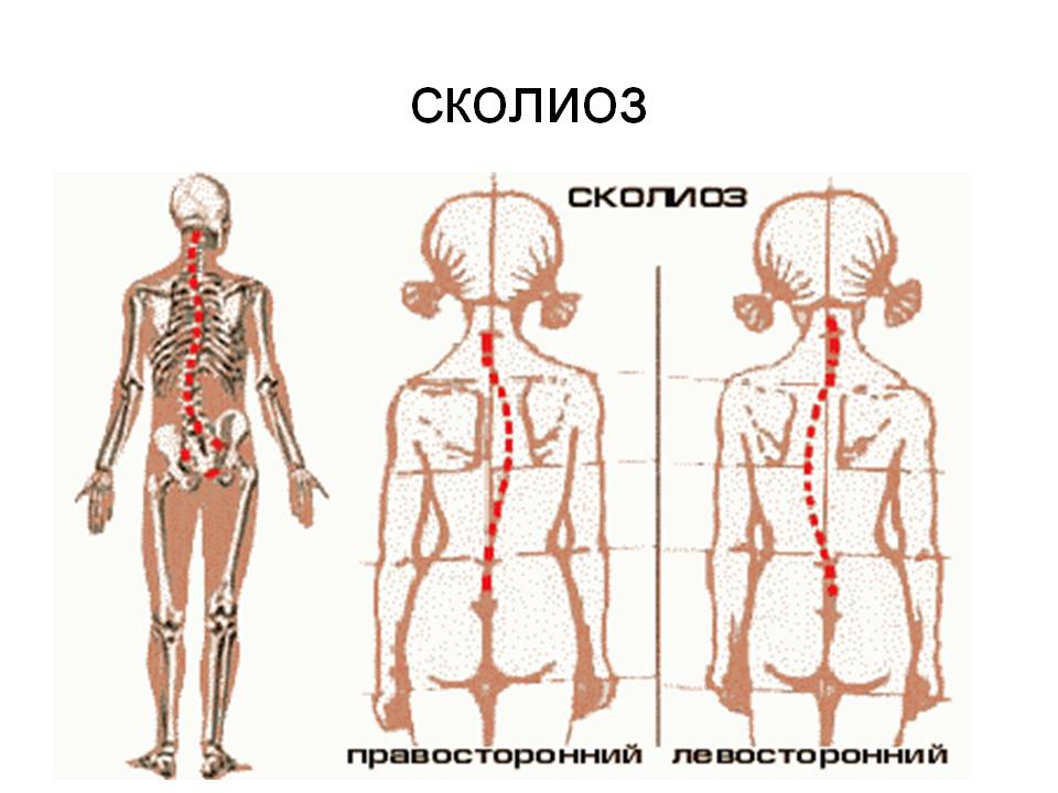 Сколиоз у ребенка