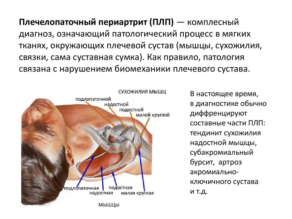 Распознать заболевание не вызовет особого труда. Люди, столкнувшиеся с болезнью, указывают на постоянную и интенсивную боль в области плечевого сустава