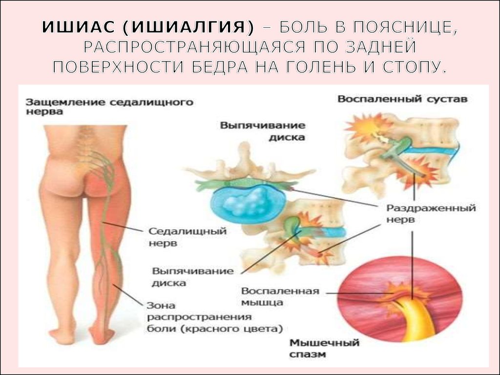 Что может спровоцировать ишиалгию