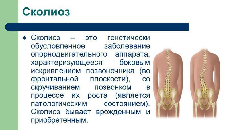 Сколиоз