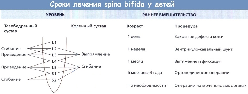 Сроки лечения спина бифида у детей