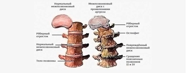 Спондилез