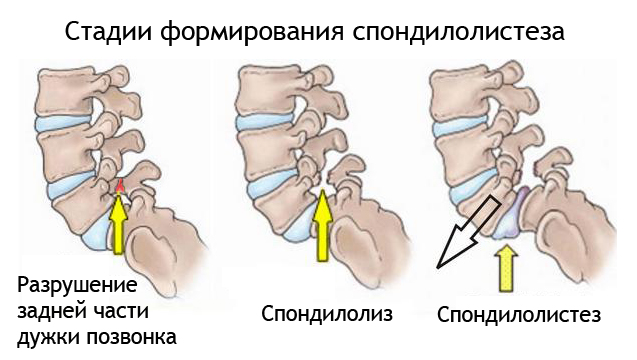 Спондилолистез