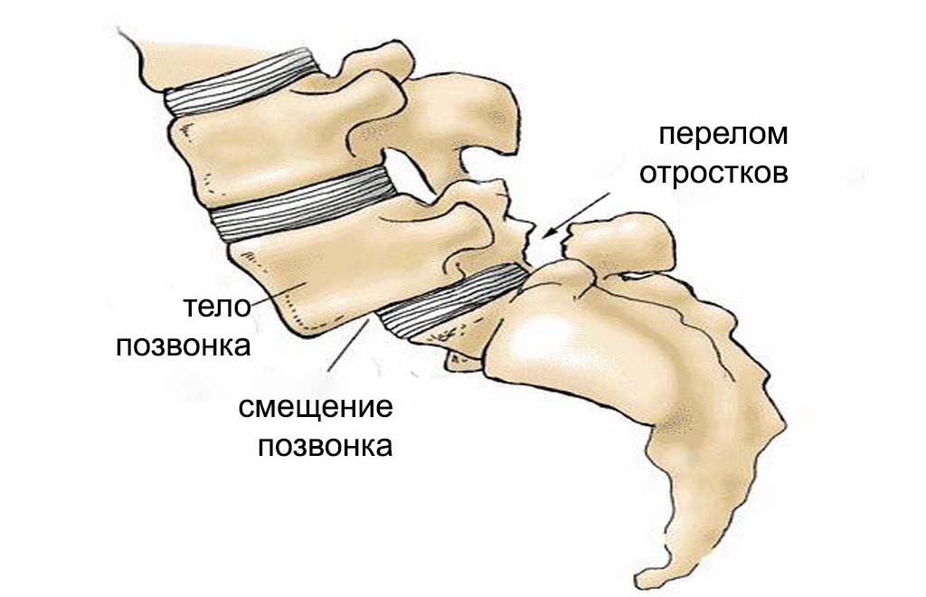 Спондилолистез 
