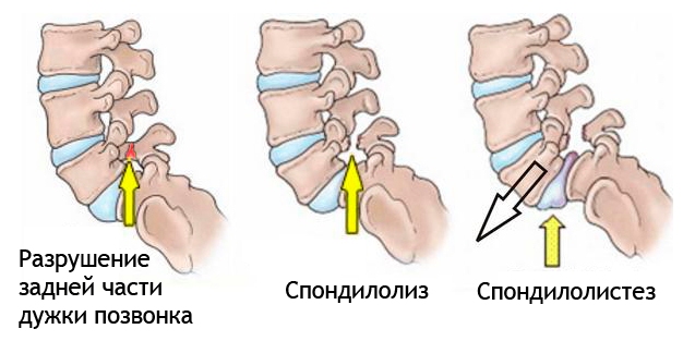 Спондилолистез