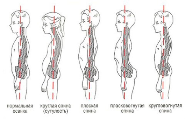 Сравнение некоторых патологических изменений кривизны позвоночника