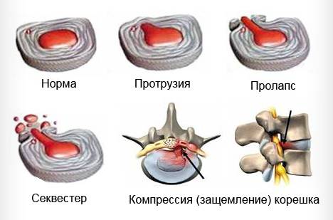 Стадии развития грыжи