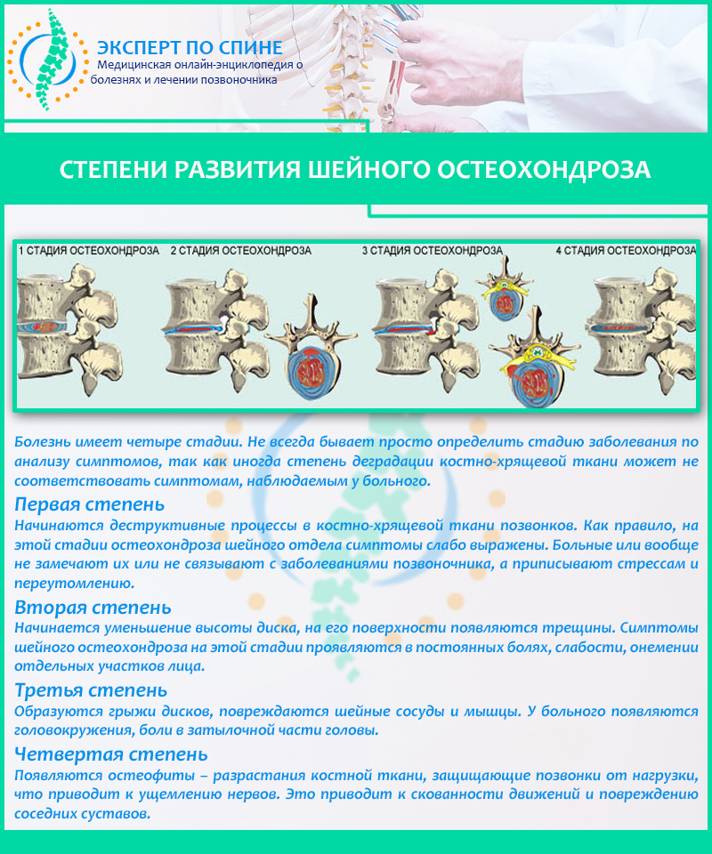 Степени развития шейного остеохондроза