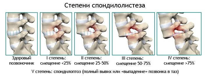 Степени спондилолистеза позвоночника