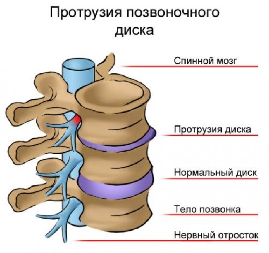 Так выглядит протрузия позвонкового диска
