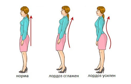 Типы лордоза