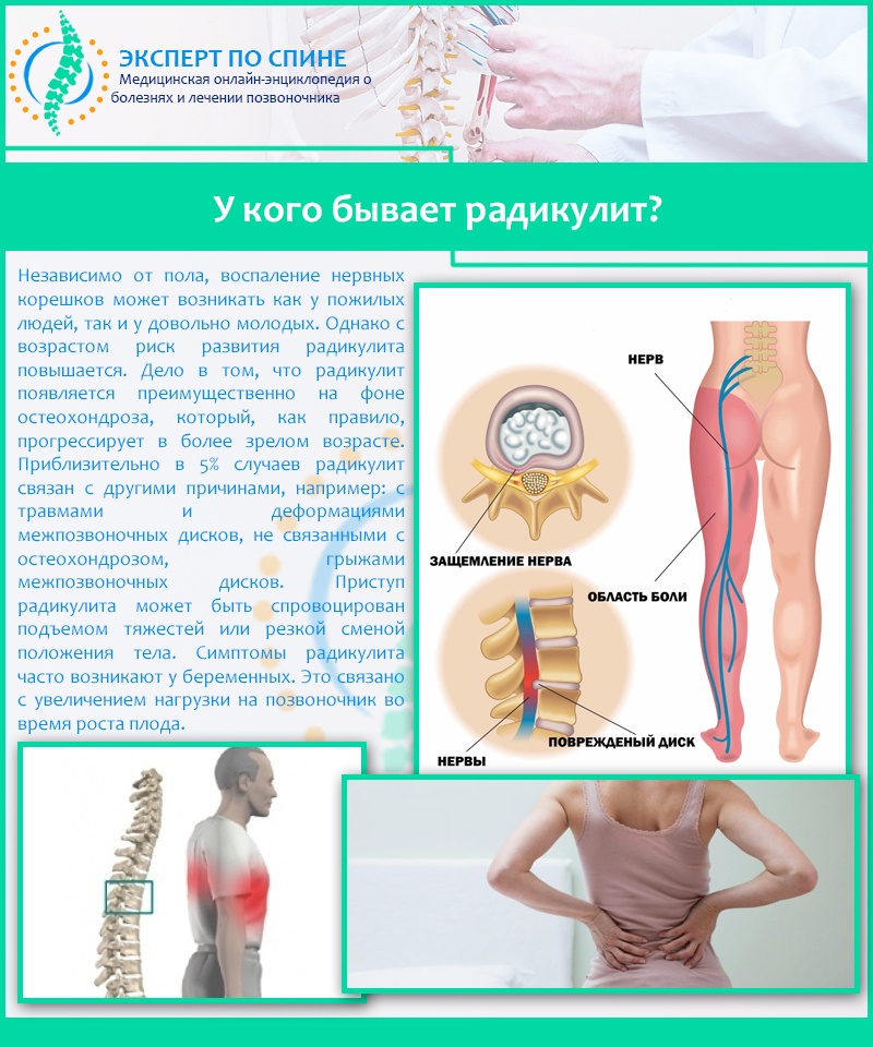 У кого бывает радикулит