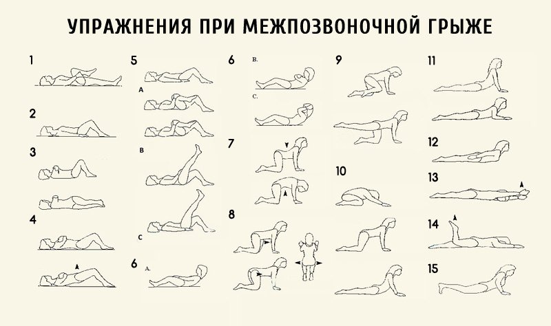 Упражнения при межпозвонковой грыже