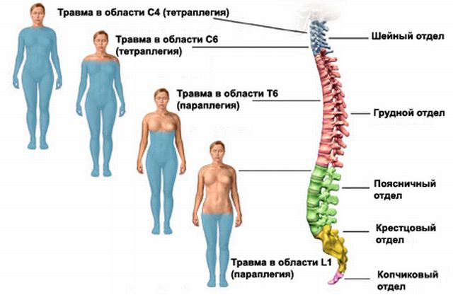 Уровни поражения спинного мозга