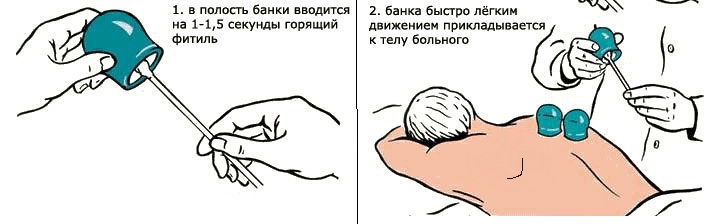 Правильная постановка медицинских банок