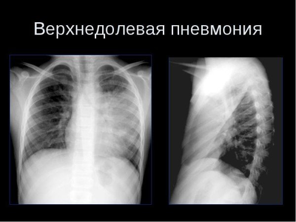 Верхнедолевая пневмония