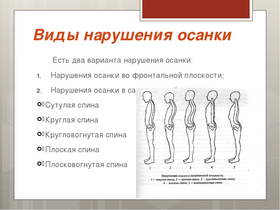 Виды нарушения осанки