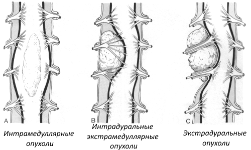 Виды опухолей