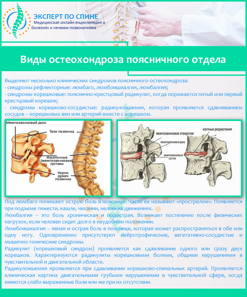 Виды остеохондроза поясничного отдела