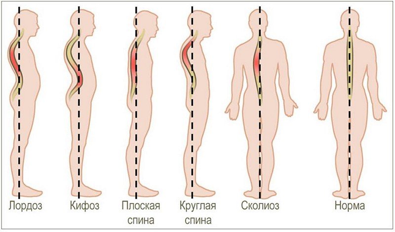 Виды сколиоза