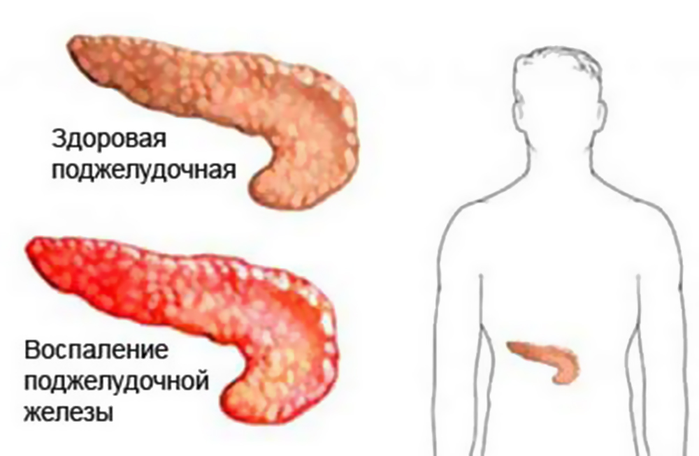 Воспаление поджелудочной железы