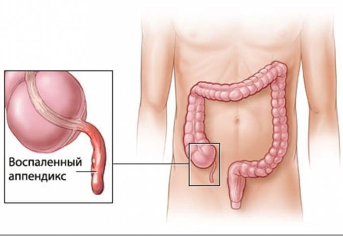 Воспаленный аппендикс