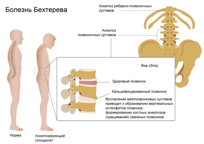 Второе название болезни Бехтерева – анкилозирующий спондилоартрит