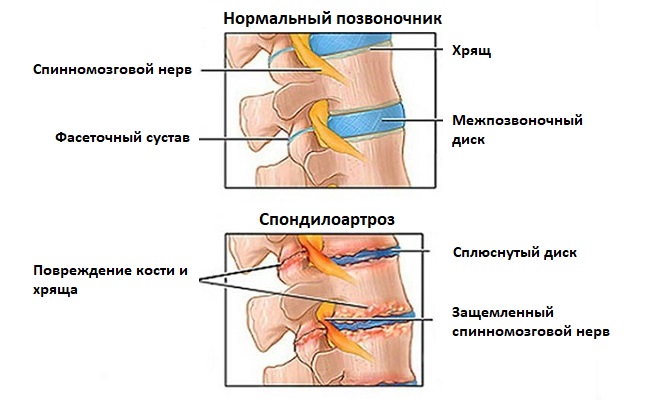 Заболевание характеризуется поражением хрящевой и костной ткани с последующим образованием наростов по краю позвонков
