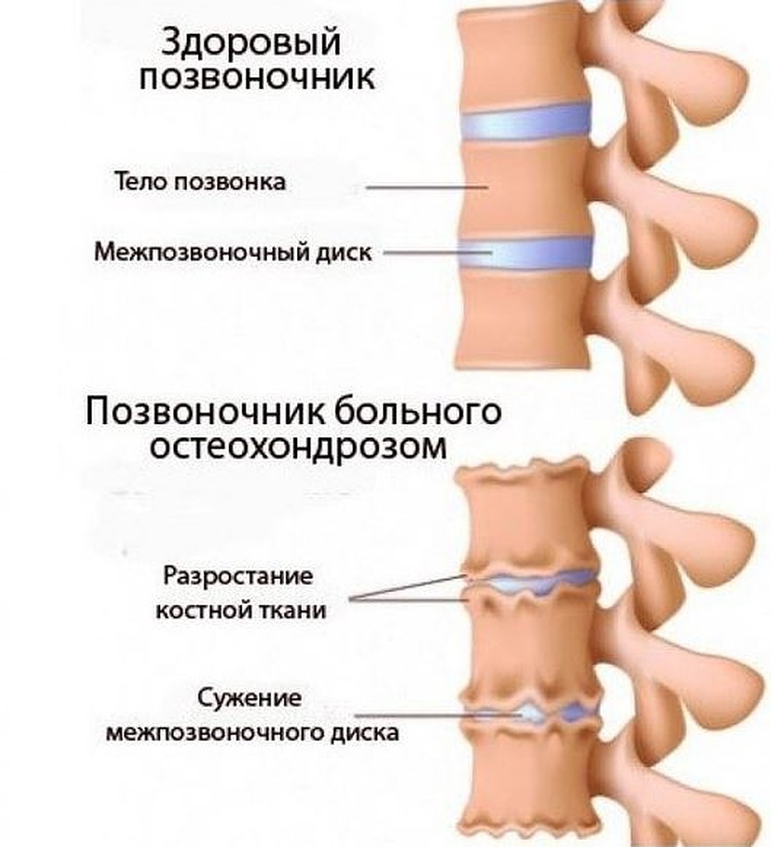 Здоровый позвоночник и позвоночник больного остеохондрозом