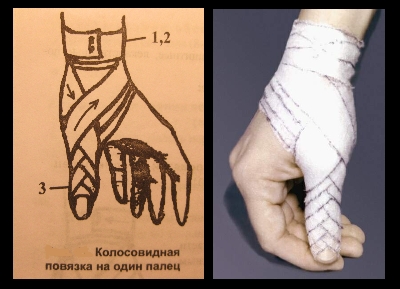 Колосовидная повязка на один палец кисти