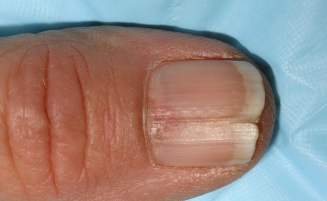 Черные полоски на ногтях приносят людям много неудобств