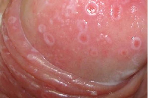 Головка при кандидозе