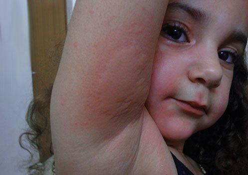 Крапивница у мальчика