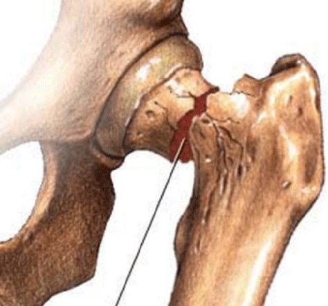 Остеопороз тазобедренного сустава