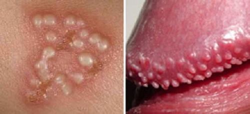 Папилломы на пенисе приносят мужчинам дискомфорт