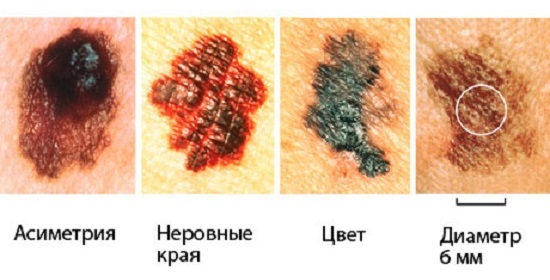 Priznaki-melanomy
