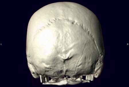 кт-черепа-сзади