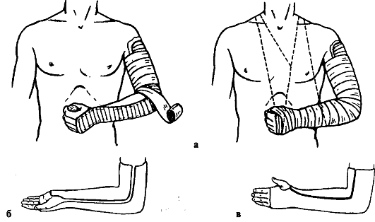 лонгета при переломе плеча.jpg1