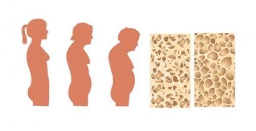 Лечение остеопороза у пожилых женщин